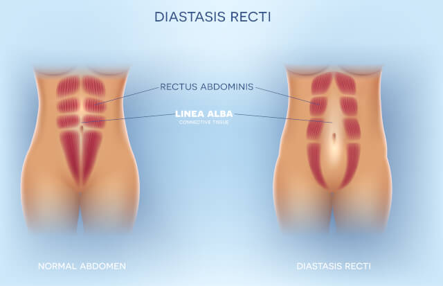 Abdominal Diastasis