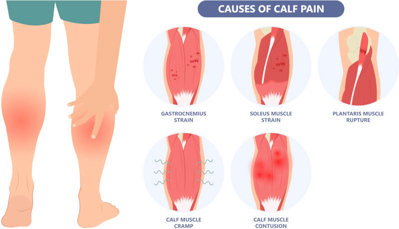 Calf Pain