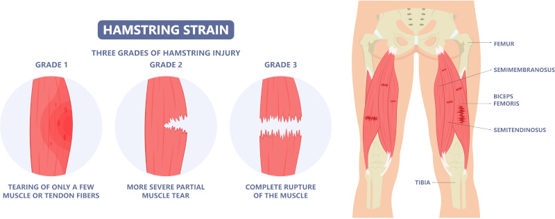 Types of hamstring strain