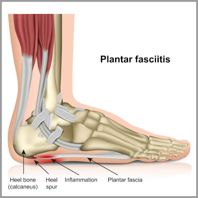 Plantar Fascia Pain