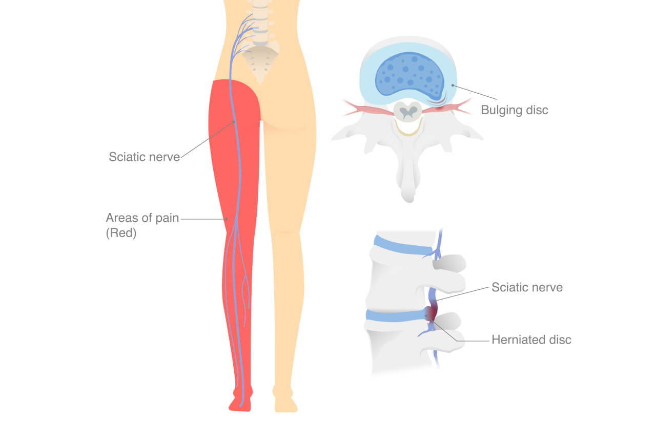 Sciatic and Piriformis